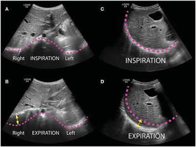 A Novel Thoracic Ultrasound Measurement After Congenital Diaphragmatic Hernia Repair Identifies Decreased <mark class="highlighted">Diaphragmatic Excursion</mark> Associated With Adverse Respiratory and Surgical Outcomes